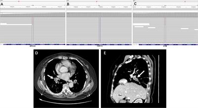 Case Report: Niraparib-Related Pulmonary Embolism During the Treatment of BRCA Mutant Advanced Ovarian Cancer